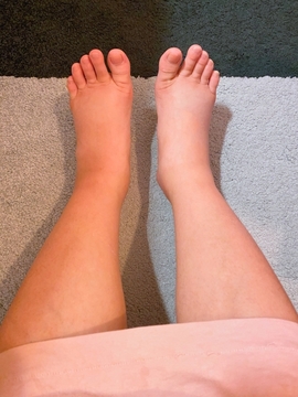 更年期におけるむくみの対策とケア方法