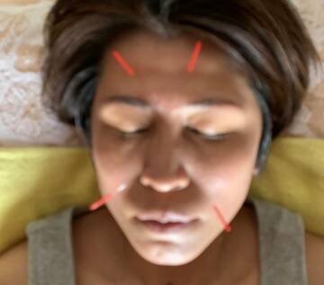 鍼灸の神秘に触れた！鼻づまり解消の驚きの効果